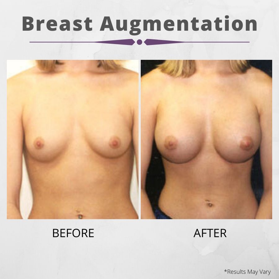Actual Patient Breast Augmentation Before and After Results 